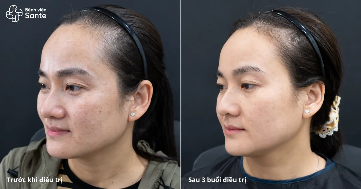Bệnh viện Sante - “Lột Sạch Nám” Với 1 Miếng Dán? Sự Thật Y Khoa Dưới Góc Nhìn Bác Sĩ Da Liễu Sante (Hình 5) Hình ảnh khách hàng trước và sau 3 buổi điều trị nám tại Khoa Thẩm mỹ Da Bệnh viện Sante