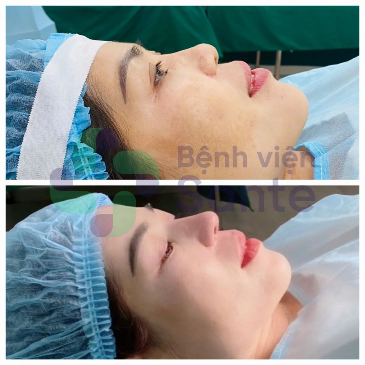 Phẫu thuật nâng mũi là gì? Bệnh viện chuyên khoa phẫu thuật nâng mũi chất lượng quốc tế HCM Phẫu thuật nâng mũi là gì? Bệnh viện chuyên khoa phẫu thuật nâng mũi chất lượng quốc tế HCM